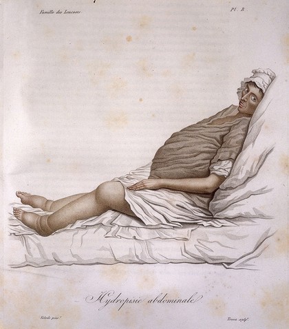 Nosologie naturelle, ou les maladies du corps humain distribuées par familles. T. 1. / [Jean-Louis-Marie Alibert].