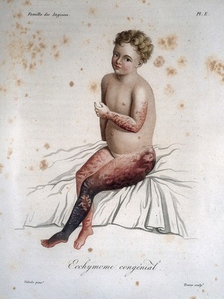 Nosologie naturelle, ou les maladies du corps humain distribuées par familles. T. 1. / [Jean-Louis-Marie Alibert].