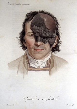 Monographie des dermatoses, ou, précis théorique et pratique des maladies de la peau / Par M. le Baron Alibert.