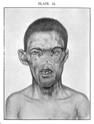 Syphilis in general practice : with special reference to the tropics / by K.K. Chatterji.