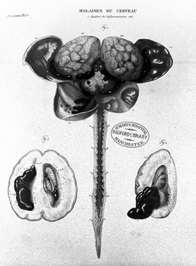 Anatomie pathologique du corps humain, ou descriptions ... des diverses altérations morbides dont le corps humain est susceptible / [J. Cruveilhier].