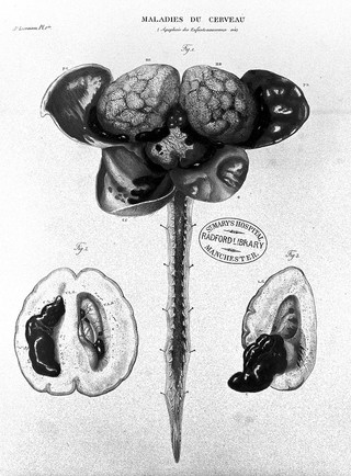 Anatomie pathologique du corps humain, ou descriptions ... des diverses altérations morbides dont le corps humain est susceptible / [J. Cruveilhier].