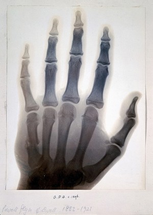 view Sir Gervas Powell Glyn, 6th Bart.: radiograph of his hand. Photograph by Sir G.P. Glyn, 1896.