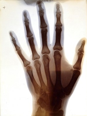 view Hand of M.H. G[lyn?]: radiograph. Photograph by Sir G.P. Glyn, ca. 1896.