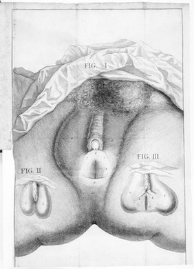 A mechanical and critical enquiry into the nature of hermaphrodites / by James Parsons.