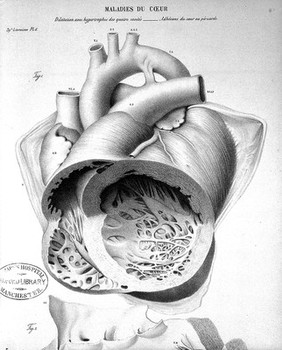 Anatomie pathologique du corps humain, ou descriptions ... des diverses altérations morbides dont le corps humain est susceptible / [J. Cruveilhier].