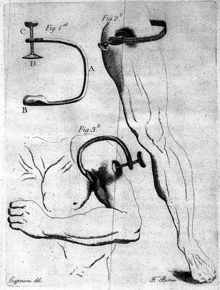 A method of preventing or diminishing pain in several operations of surgery / [James Moore].