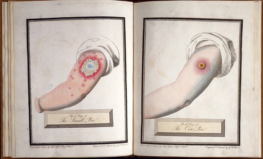 30 plates of the small pox and cow pox drawn from nature / [by Capt. Gold, R.A.] Published [and engraved] by G.K.