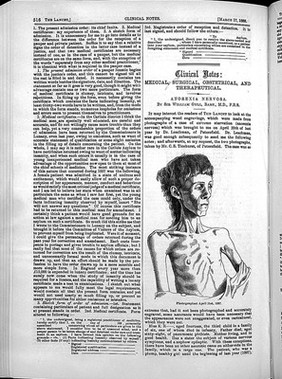 Case of anorexia nervosa in female