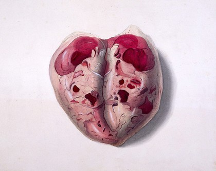 A cystic tumour with necrosis. Watercolour.