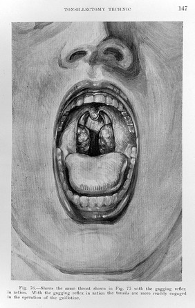 Tonsillectomy : by means of the alveolar eminence of the mandible and a guillotine with a review of the collateral issues / by Greenfield Sluder.