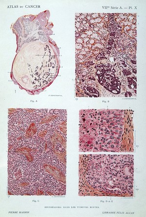 view J. Darier, Atlas du cancer: epithelioma dans tumeurs mixtes