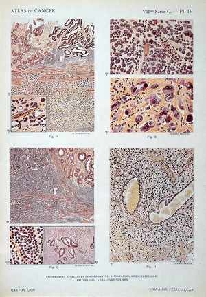 view J. Darier, Atlas du cancer: epitheliomas