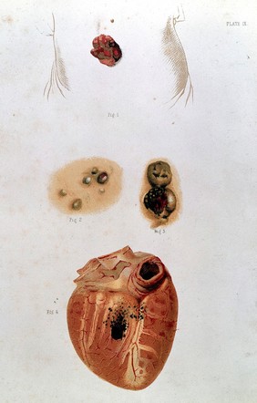 Clinical illustrations of various forms of cancer and of other diseases likely to be mistaken for them : with especial reference to their surgical treatment / by Oliver Pemberton.