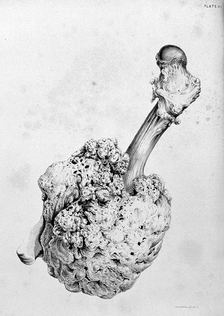 Clinical illustrations of various forms of cancer and of other diseases likely to be mistaken for them : with especial reference to their surgical treatment / by Oliver Pemberton.