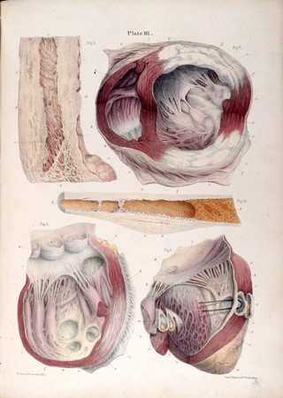 Pathological anatomy : illustrations of the elementary forms of disease / By Robert Carswell.