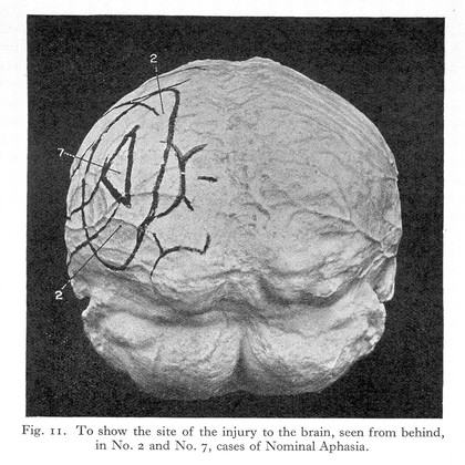 Aphasia and kindred disorders of speech / by Henry Head.