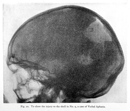 Aphasia and kindred disorders of speech / by Henry Head.