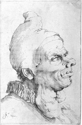 The head of a man with large goitres on his neck. Etching by Jusepe de Ribera.