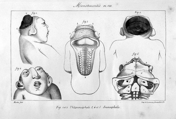 Histoire générale et particulière des anomalies de l'organisation chez l'homme et les animaux, ouvrage comprenant des recherches sur les caractères, la classification ... les lois et les causes de monstruosités, des variétés et vices de conformation, ou traité de tératologie / [Isidore Geoffroy Saint-Hilaire].