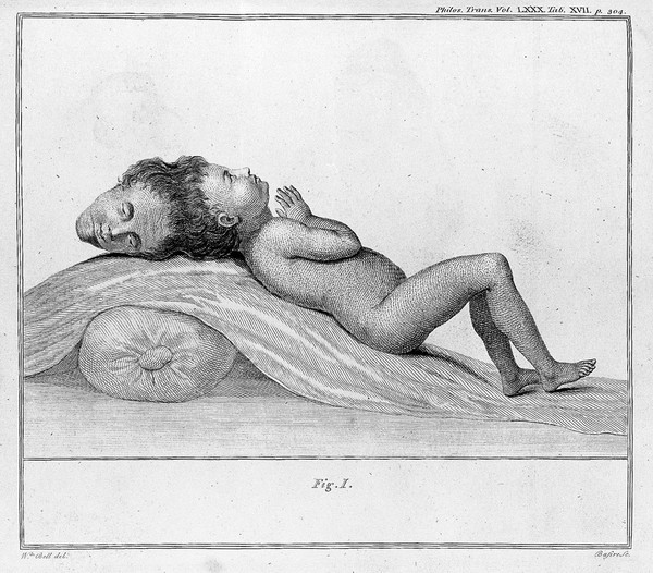 An account of a child with a double head / [Sir Everard Home].