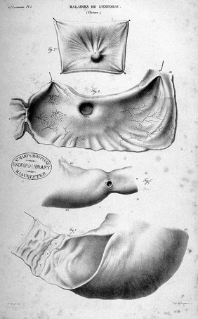 Anatomie pathologique du corps humain, ou descriptions ... des diverses altérations morbides dont le corps humain est susceptible / [J. Cruveilhier].