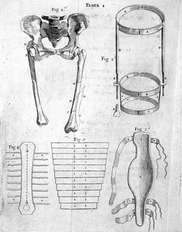 Essays on several important subjects in surgery: chiefly on the nature and cure of fractures of the long bones of the extremities. Particularly those of the thigh and leg, whether simple of compound : for which a new method of retention is proposed. The whole illustrated with cooper-plates / [John Aitken].