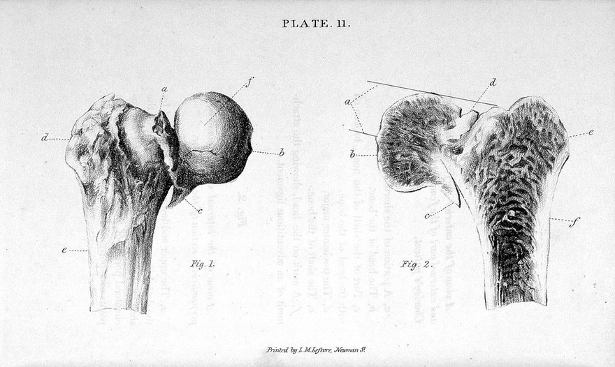 Practical remarks on the nature and treatment of fractures of the trunk and extremities. Being the substance of that portion of his lectures which relates to this subject ... / By Joseph Amesbury.