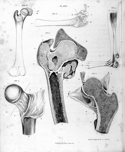 Fracture of the cervix femoris