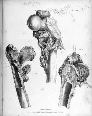 Observations on injuries of the spine and of the thigh bone: in two lectures. Delivered in the school of Great Windmill street / [Sir Charles Bell].