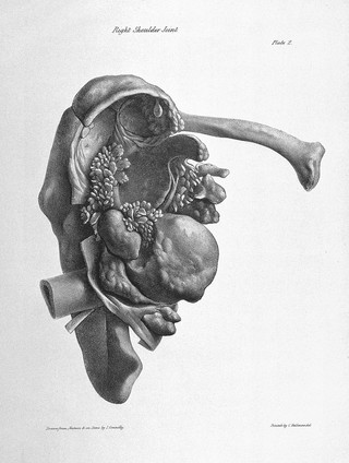 Illustrations of the effects of rheumatic gout or chronic rheumatic arthritis on all the articulations : with descriptive and explanatory statements / by Robert Adams.