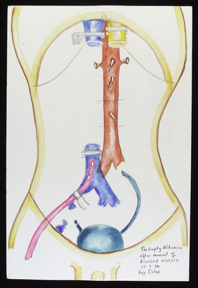 An empty abdomen during a six-organ transplant. Watercolour by Sir Roy Calne, 1994.