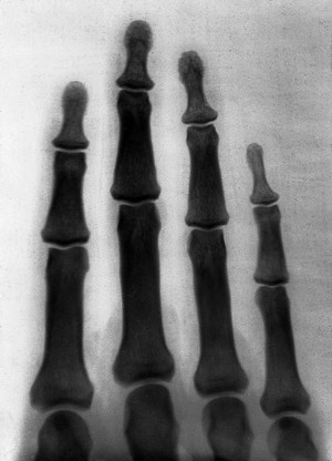 view The bones of the human fingers. Photograph of X-ray attributed to L. Ropner, 1897.