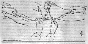 view Avelings transfusion apparatus; the Lancet, 1872