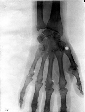 view Bones of the hand of W. Scott-Moncrieff, showing the effect of a bullet-wound. Radiograph, 1900/1904.