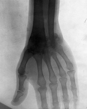 view Bones of the hand of Sergeant Mather, possibly of 2nd Middlesex Regiment, showing tuberculous disease of the wrist. Radiograph, 1900/1904.