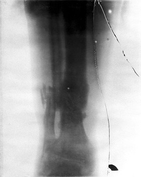 A fracture of the tibia and fibula of Major William Scott-Moncrieff at the battle of Spion Kop, South Africa, April 1900. Radiograph, 1900/1904.