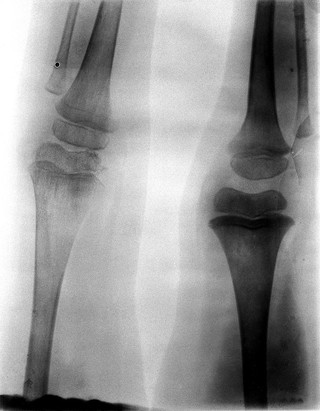 The left and right knee-joints of Frank Burgess, probably a soldier in the South African War, after excision of the left knee. Radiograph, 1900/1904.