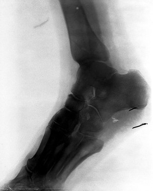 view Bones of the ankle, and part of the foot and leg. Radiograph, 1900/1904.