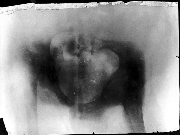 Pelvis of E. Welch, showing disease of right hip and dislocaton of left hip. Radiograph, 1900/1904.