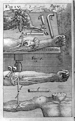 view Therapy: blood transfusion