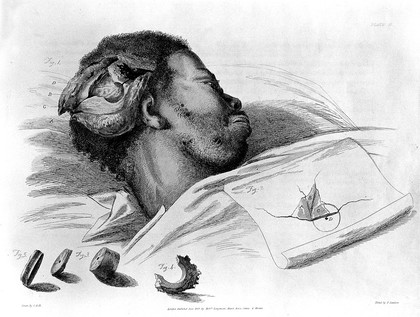 Illustrations of the great operations of surgery, trepan, hernia, amputation, aneurism, and lithotomy / [Sir Charles Bell].