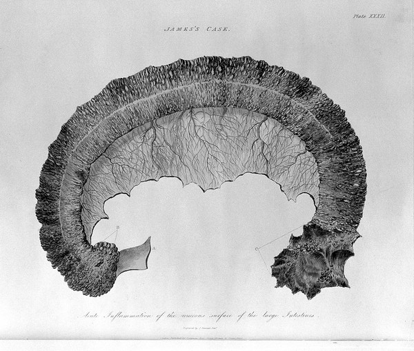 Researches into the causes, nature, and treatment of the more prevalent diseases of India, and of warm climates generally. Illustrated with cases, post mortem examinations, and numerous coloured engravings of morbid structures / by James Annesley.