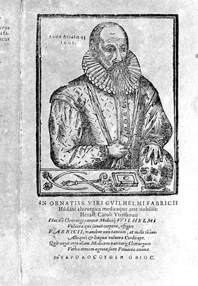 Guilielmi Fabricii Hildani ... Observationum et curationum chirurgicarum centuriæ. In qua inclusæ sunt viginti et quinque, antea seorsim æditæ: reliquæ nunc cum nonnullis instrumentorum, ab autore inventorum delineationibus, in gratiam & utilitatem artis chirurgicæ in lucem prodeunt. [Centuria prima] Cùm indice / [Wilhelm Fabricius Hildanus].