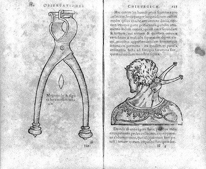 Guilielmi Fabricii Hildani ... Observationum et curationum chirurgicarum centuriæ. In qua inclusæ sunt viginti et quinque, antea seorsim æditæ: reliquæ nunc cum nonnullis instrumentorum, ab autore inventorum delineationibus, in gratiam & utilitatem artis chirurgicæ in lucem prodeunt. [Centuria prima] Cùm indice / [Wilhelm Fabricius Hildanus].