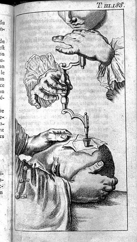 Traité des opérations de chirurgie / [René-Jacques Croissant de Garengeot].