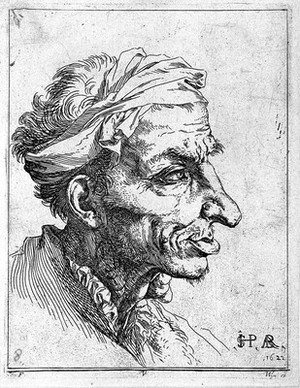 view The head of a man with goitre. Etching by Jusepe de Ribera, 1622.