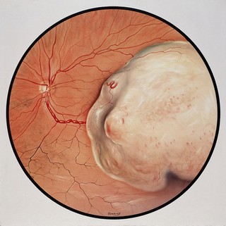 Malignant melanoma of the choroid; Gabriel Donald