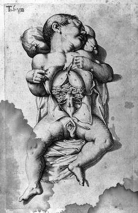 De formato foetu liber singularis aeneis figuris exornatus. Epistolae duae anatomicae. Tractatus de arthritide / Opera posthuma, studio Liberalis Cremae ... edita.