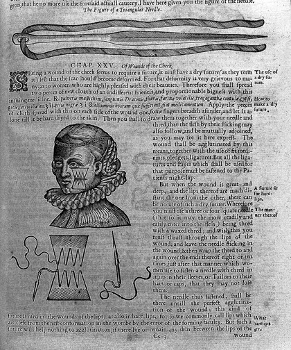 The workes of that famous chirurgion Ambrose Parey ... / Translated out of Latine and compared with the French by Tho. Johnson [and in part by G. Baker] Whereunto are added three tractates out of Adrianus Spigelius of the veines, arteries, and nerves. With large figures. ; Also a table of the bookes and chapters.